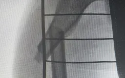 В Бурятии 7-летний ребенок сломал ногу во время катания на ватрушке