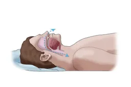 1.76亿国人受睡眠呼吸障碍困扰 仅约1%得到及时治疗｜世界睡眠日