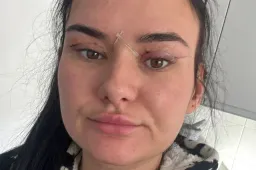 Открытые раны и глаза, которые не закрываются: женщины предупреждают об опасности дешевой блефаропластики